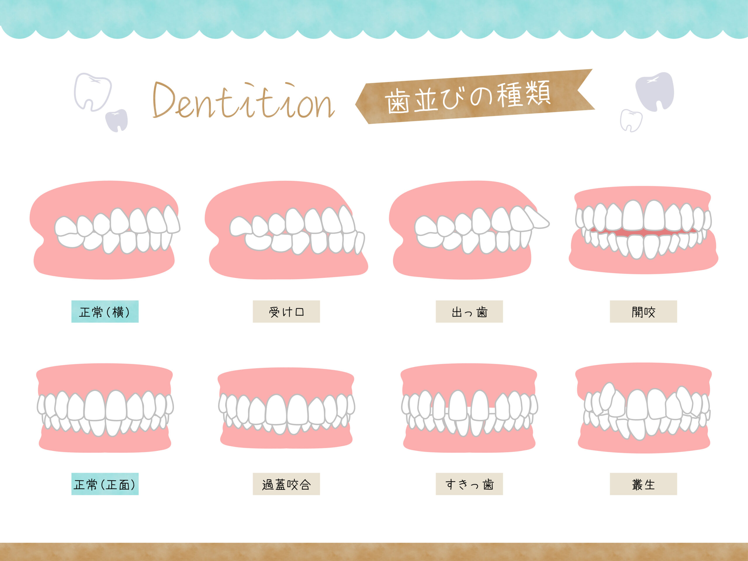 不正咬合（ふせいこうごう）