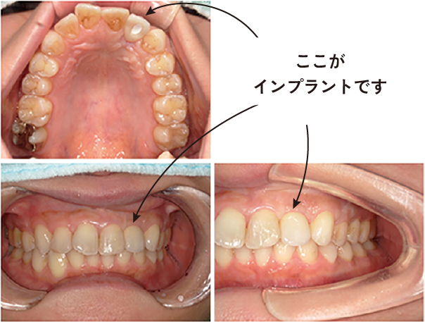 口腔内様子