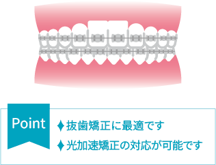 ワイヤー矯正