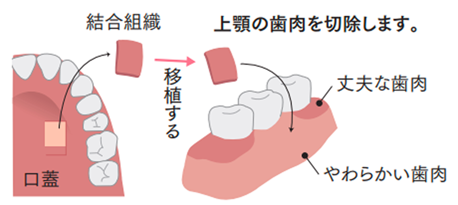 インプラント｜安城市今池町の新安城歯科
