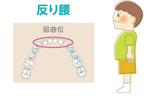 反 腰